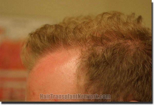 Hair restoration procedure results