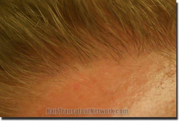 Hair restoration procedure results