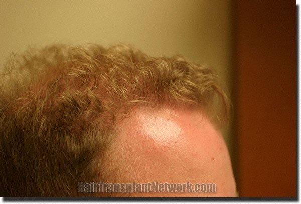 Hair restoration procedure results