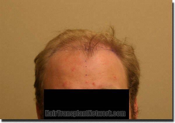 Hair restoration procedure results