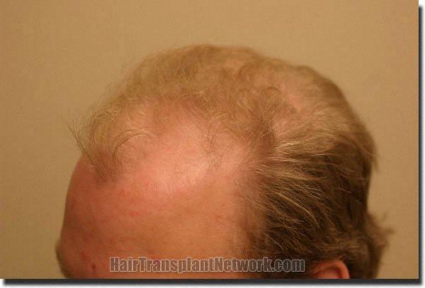 Hair restoration procedure results