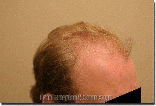 Hair restoration procedure results