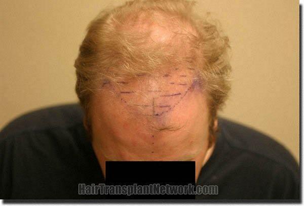 Hair restoration procedure results