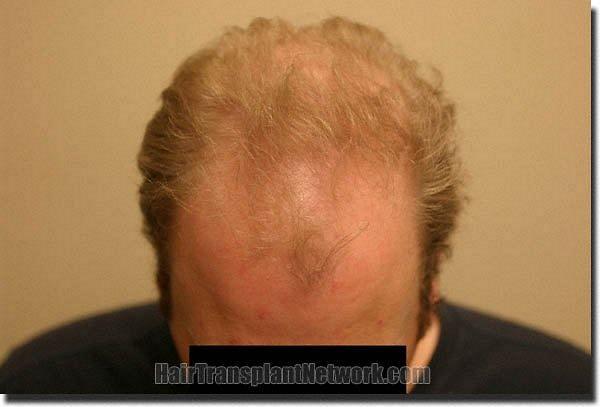 Hair restoration procedure results