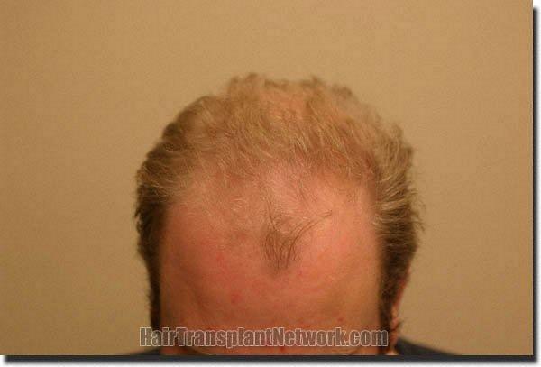 Hair restoration procedure results