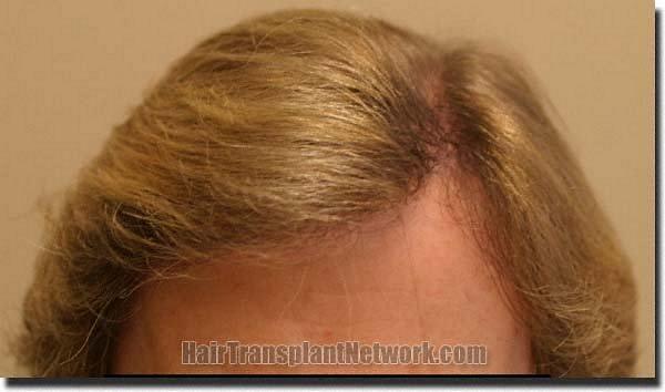 Hair restoration procedure results