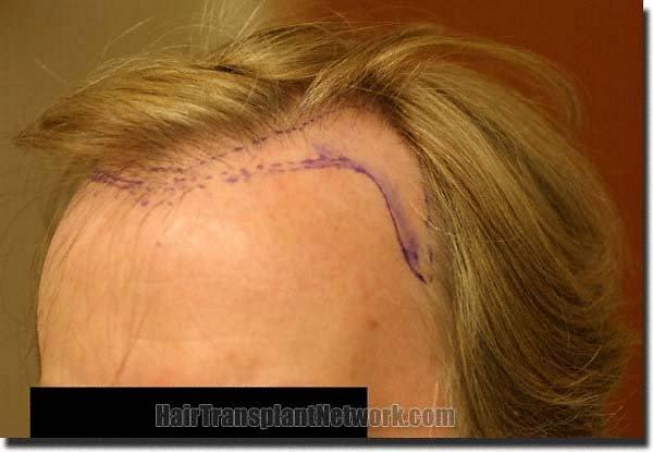 Hair restoration procedure results