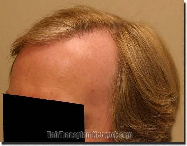 Hair restoration procedure results