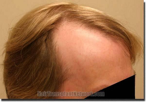 Hair restoration procedure results