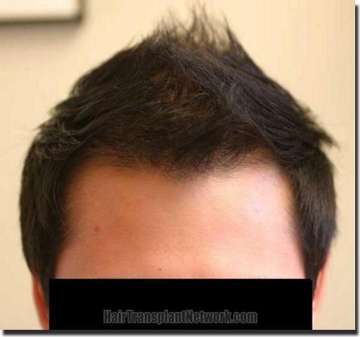 Hair restoration procedure results