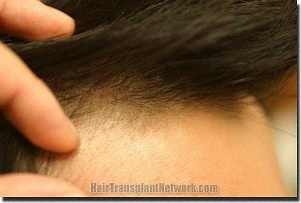 Hair restoration procedure results