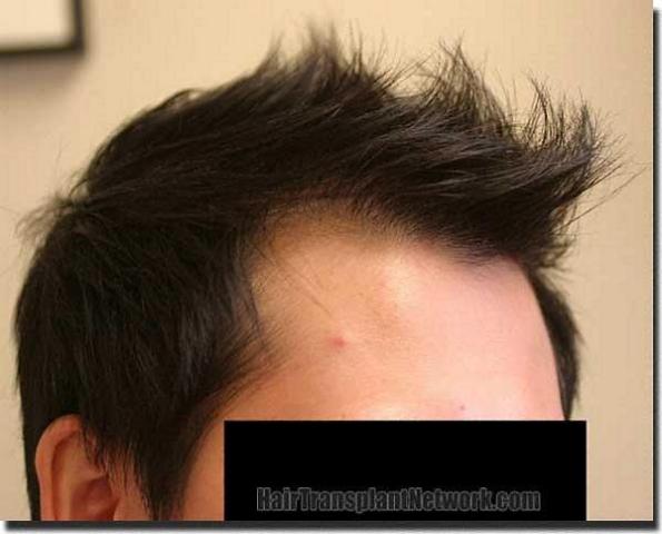 Hair restoration procedure results