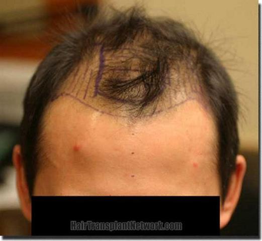 Hair restoration procedure results