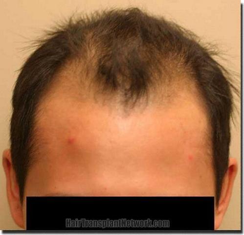 Hair restoration procedure results