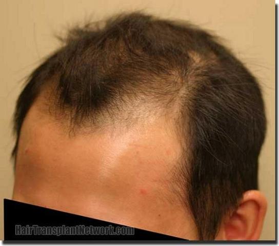 Hair restoration procedure results