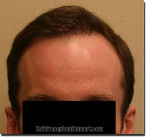 Hair restoration procedure results