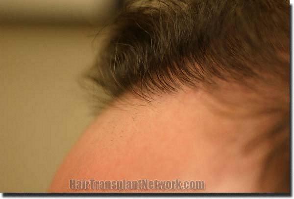 Hair restoration procedure results