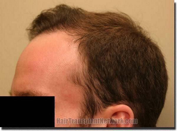 Hair restoration procedure results