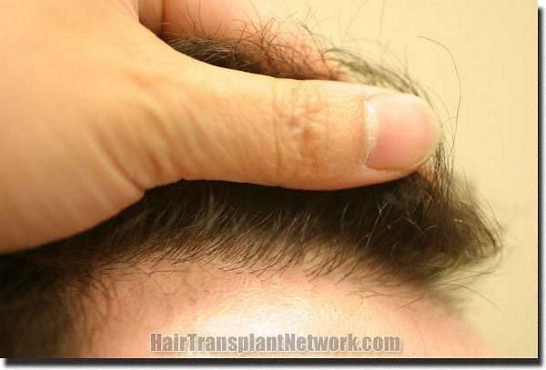 Hair restoration procedure results