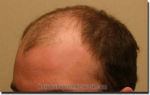 Hair restoration procedure results