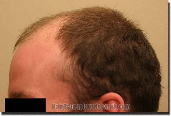 Hair restoration procedure results