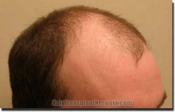 Hair restoration procedure results