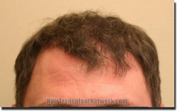 Hair restoration procedure results