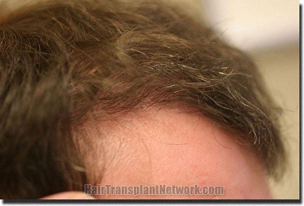 Hair restoration procedure results