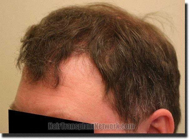 Hair restoration procedure results