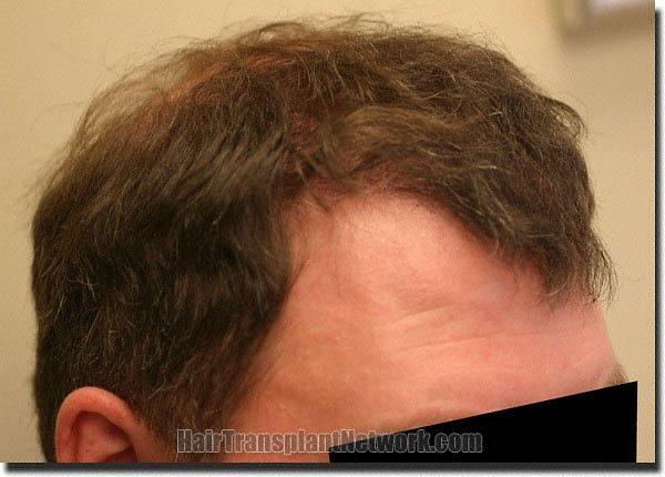 Hair restoration procedure results