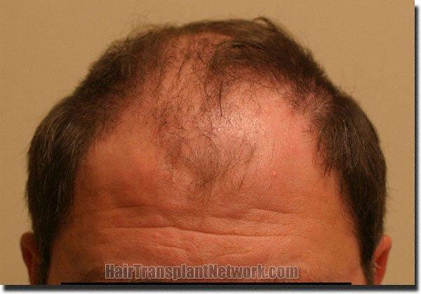 Hair restoration procedure results