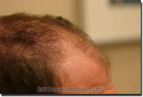 Hair restoration procedure results