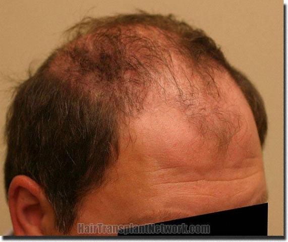 Hair restoration procedure results