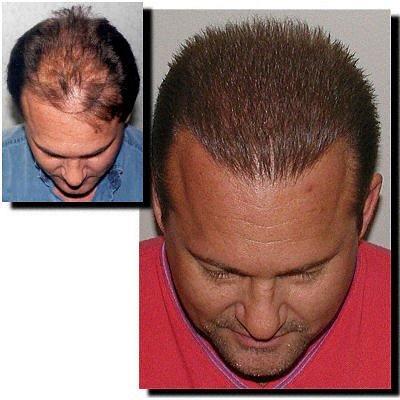 Hair restoration procedure results