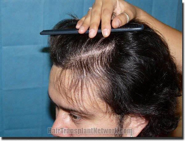 Hair restoration procedure results