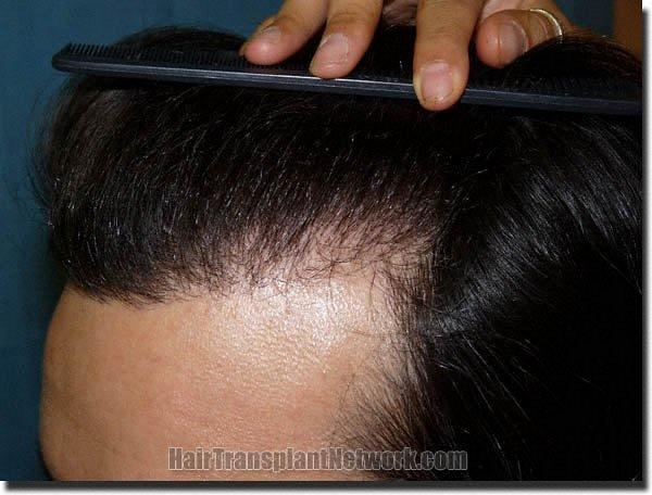 Hair restoration procedure results