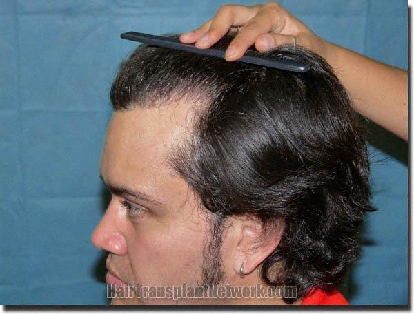 Hair restoration procedure results