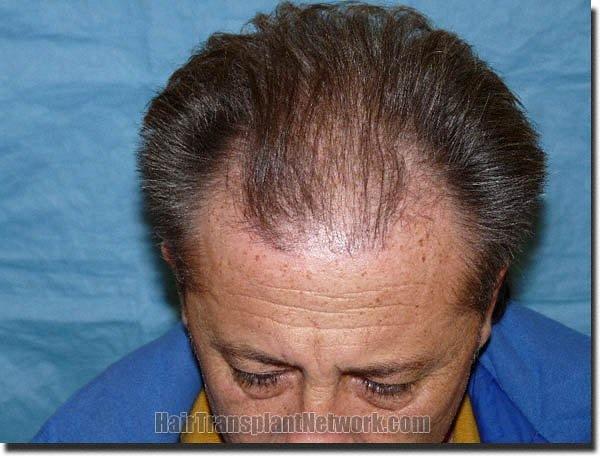 Hair restoration procedure results