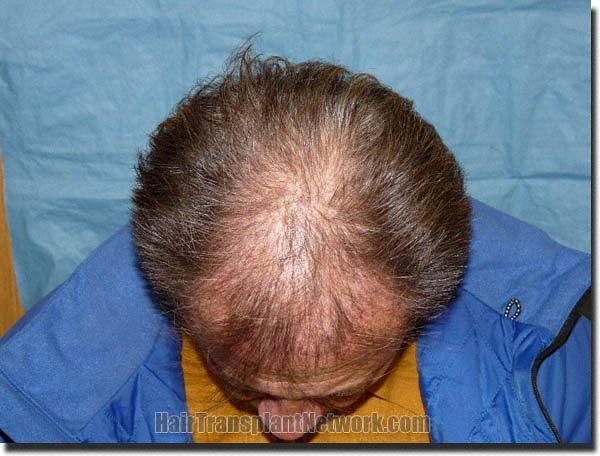 Hair restoration procedure results