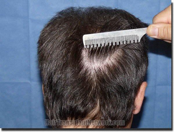 Hair restoration procedure results