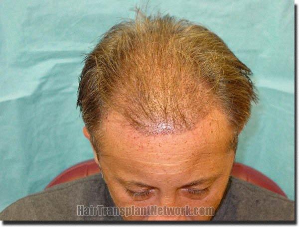 Hair restoration procedure results