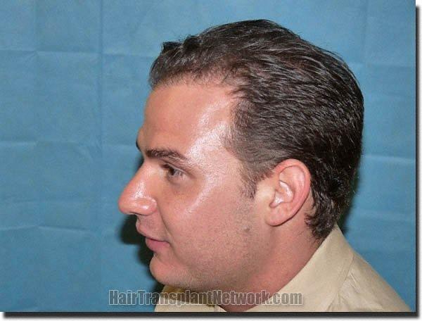 Hair restoration procedure results