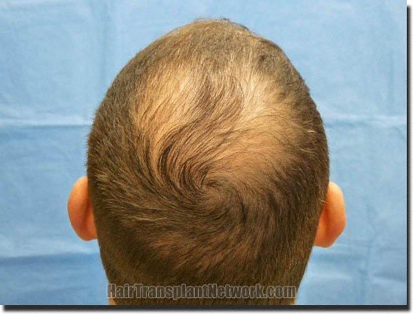 Hair restoration procedure results