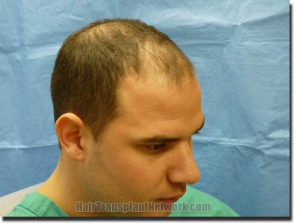 Hair restoration procedure results