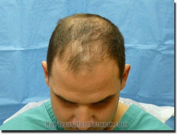 Hair restoration procedure results