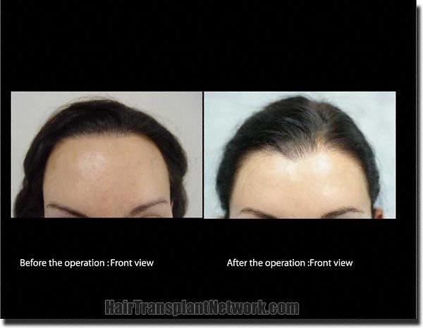 Hair restoration procedure results