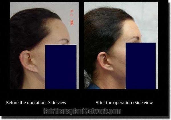 Hair restoration procedure results