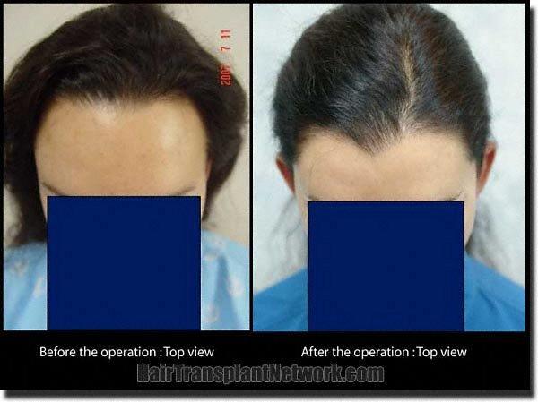 Hair restoration procedure results