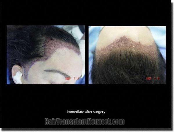 Hair restoration procedure results