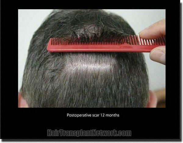 Hair restoration procedure results